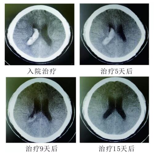 腦出血你不得不引起重視的疾?。。。?></a></div>
               
 					<div   id=