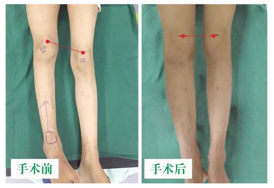 女孩墜梯右腿縮短5cm，幸得醫(yī)生及時診治恢復正常腿型